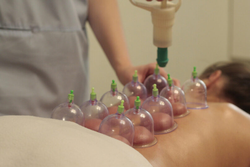 Cupping-Therapy